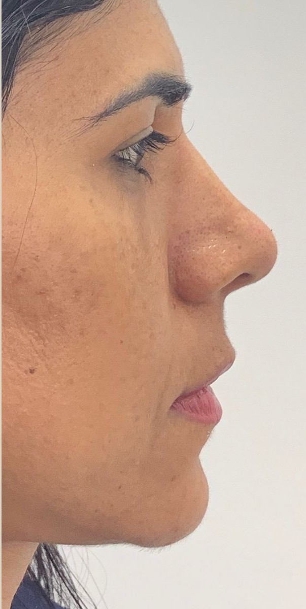 Dermal Fillers After treatment at Dexa Clinic
